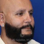 after male rhinoplasty right angle view of patient 21756