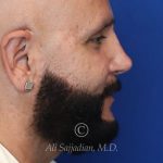 after male rhinoplasty right side view of patient 21756