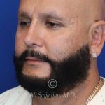 after male rhinoplasty left angle view of patient 21756