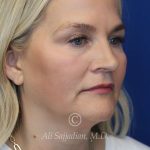 before rhinoplasty right angle view of female patient 21603