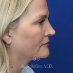 before rhinoplasty right side view of female patient 21603