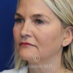before rhinoplasty left angle view of female patient 21603