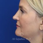 before rhinoplasty left side view of female patient 21603