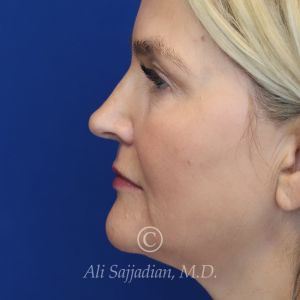 before rhinoplasty left side view of female patient 21603