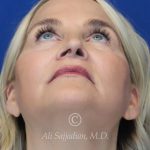 before rhinoplasty upward view of female patient 21603