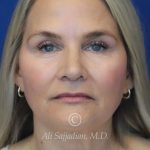 before rhinoplasty front view of female patient 21603