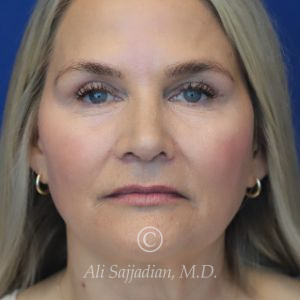 before rhinoplasty front view of female patient 21603