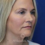 after rhinoplasty right angle view of female patient 21603