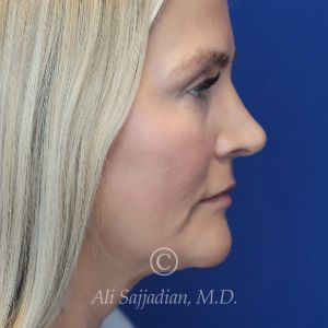 after rhinoplasty right side view of female patient 21603