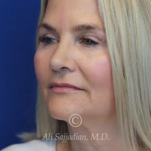 after rhinoplasty left angle view of female patient 21603