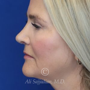 after rhinoplasty left side view of female patient 21603