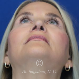 after rhinoplasty upward view of female patient 21603