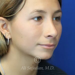 after rhinoplasty right angle view of female patient 21616