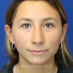 after rhinoplasty front view of female patient 21616