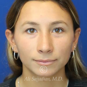 after rhinoplasty front view of female patient 21616