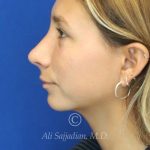after rhinoplasty left side view of female patient 21616