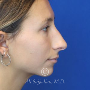 before after rhinoplasty right side view of female patient 21616