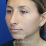 before rhinoplasty left angle view of female patient 21616