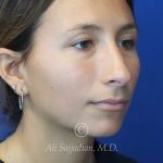before rhinoplasty left angle view of female patient 21616