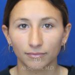 before rhinoplasty front view of female patient 21616