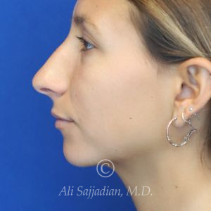 before rhinoplasty left side view of female patient 21616