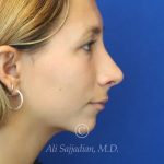after rhinoplasty right side view of female patient 21616