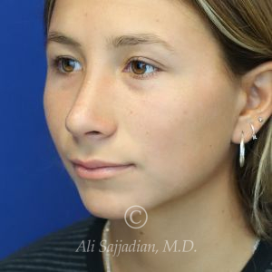 after rhinoplasty left angle view of female patient 21616