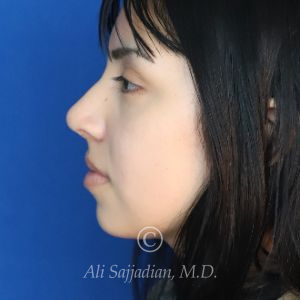 before rhinoplasty left side view of female patient 21628