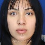 before rhinoplasty front view of female patient 21628