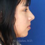 before rhinoplasty right side view of female patient 21628