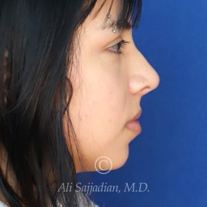 before rhinoplasty right side view of female patient 21628