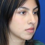 before rhinoplasty right angle view of female patient 21628