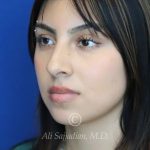 before rhinoplasty left angle view of female patient 21628