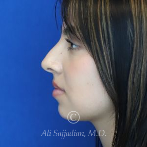 before rhinoplasty left side view of female patient 21628