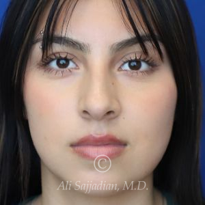 after rhinoplasty front view of female patient 21628
