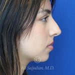 after rhinoplasty right side view of female patient 21628