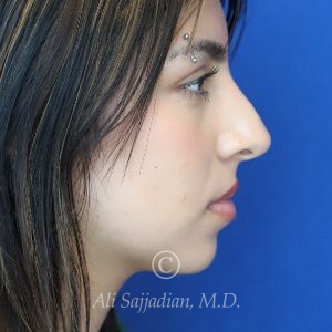 after rhinoplasty right side view of female patient 21628