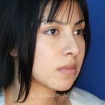 after rhinoplasty right angle view of female patient 21628
