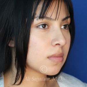 after rhinoplasty right angle view of female patient 21628