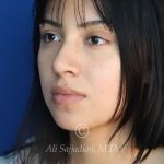 after rhinoplasty left angle view of female patient 21628