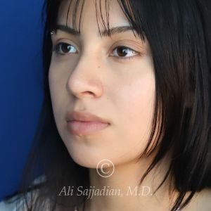 after rhinoplasty left angle view of female patient 21628