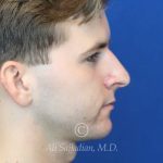 before rhinoplasty right side view of male patient 21640