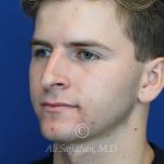 before rhinoplasty left angle view of male patient 21640
