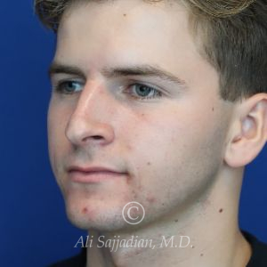 before rhinoplasty left angle view of male patient 21640