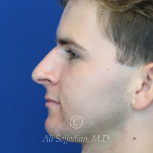 before rhinoplasty left side view of male patient 21640