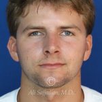 after rhinoplasty front view of male patient 21640