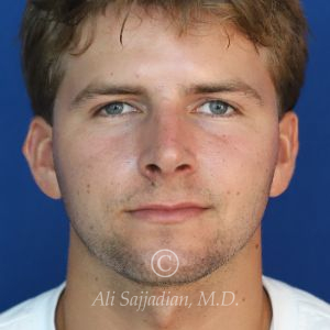 after rhinoplasty front view of male patient 21640