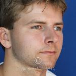 after rhinoplasty right angle view of male patient 21640