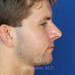 after rhinoplasty right side view of male patient 21640