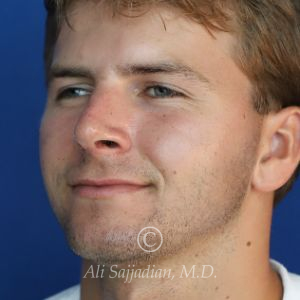 after rhinoplasty left angle view of male patient 21640